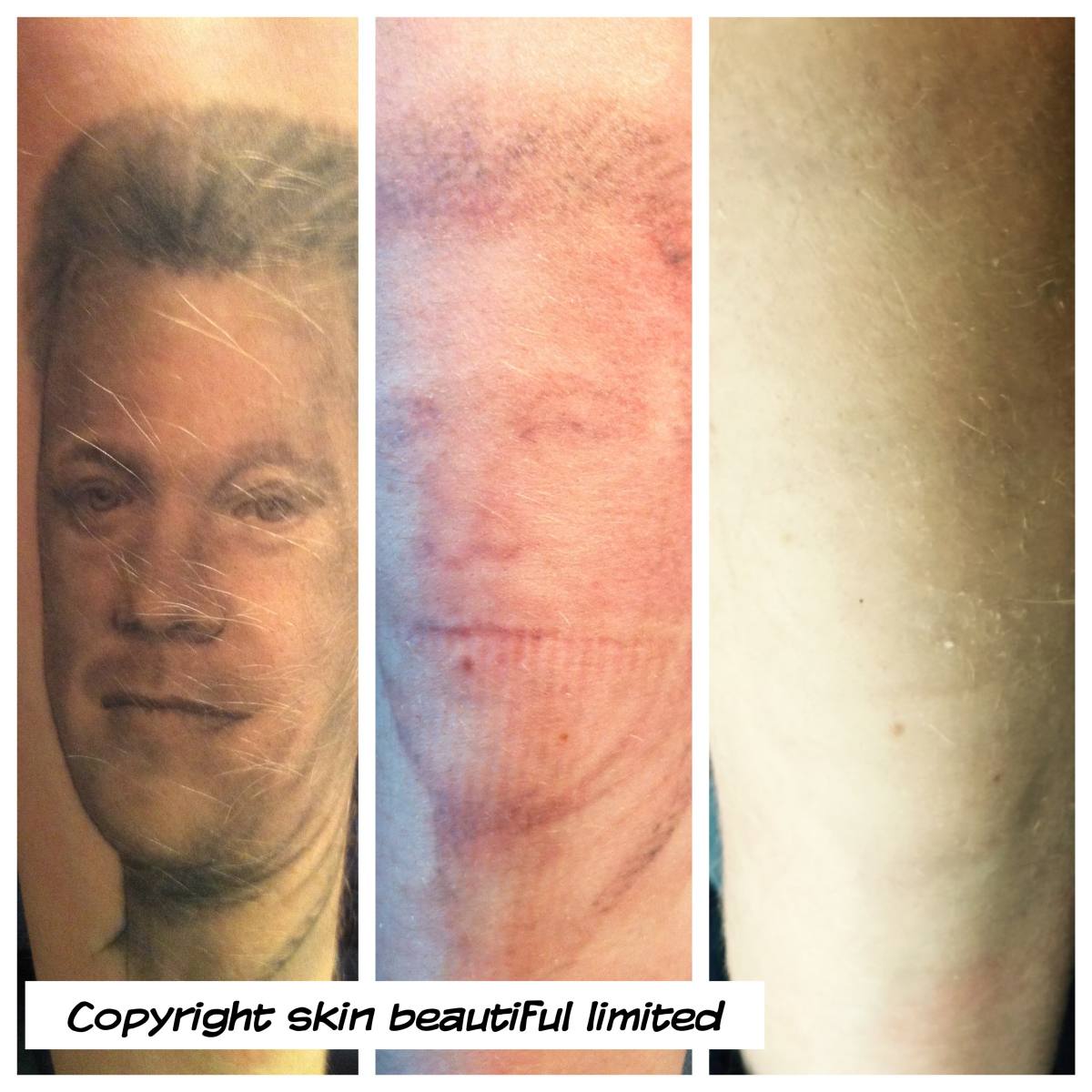 Tattoo Removal - Skin Beautiful Tattoo Removal - Skin Beautiful