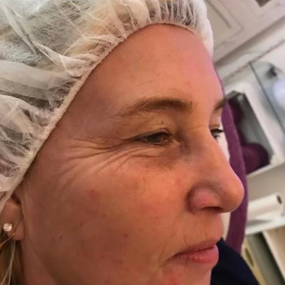 Cryotherapy in Chichester