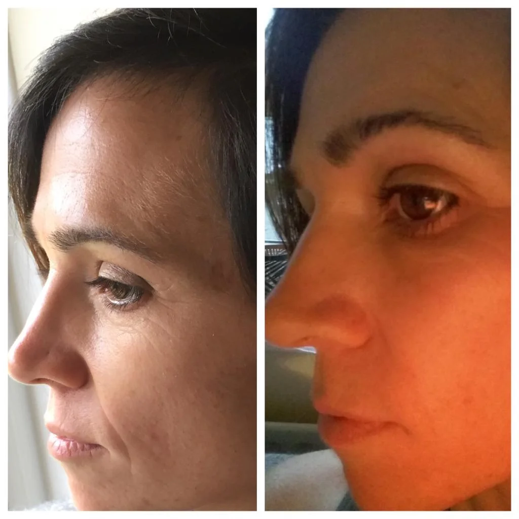 Laser skin rejuvenation Chichester