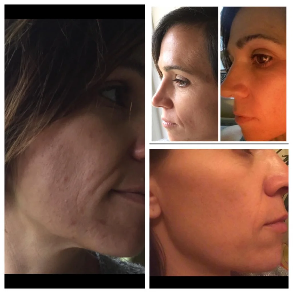 Laser skin rejuvenation Chichester