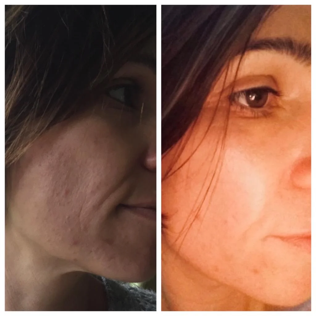 Laser skin rejuvenation Chichester