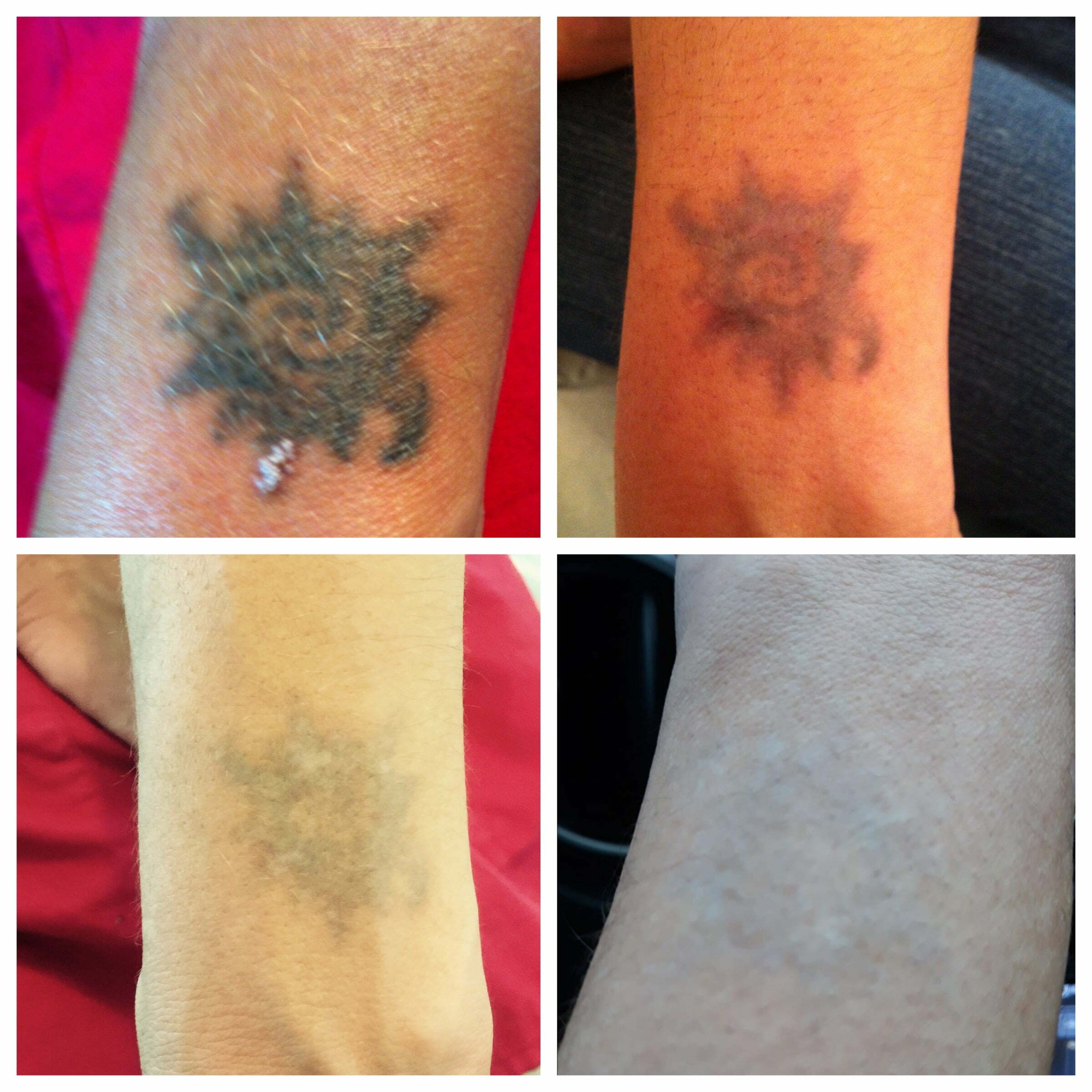 Tattoo Removal - Skin Beautiful