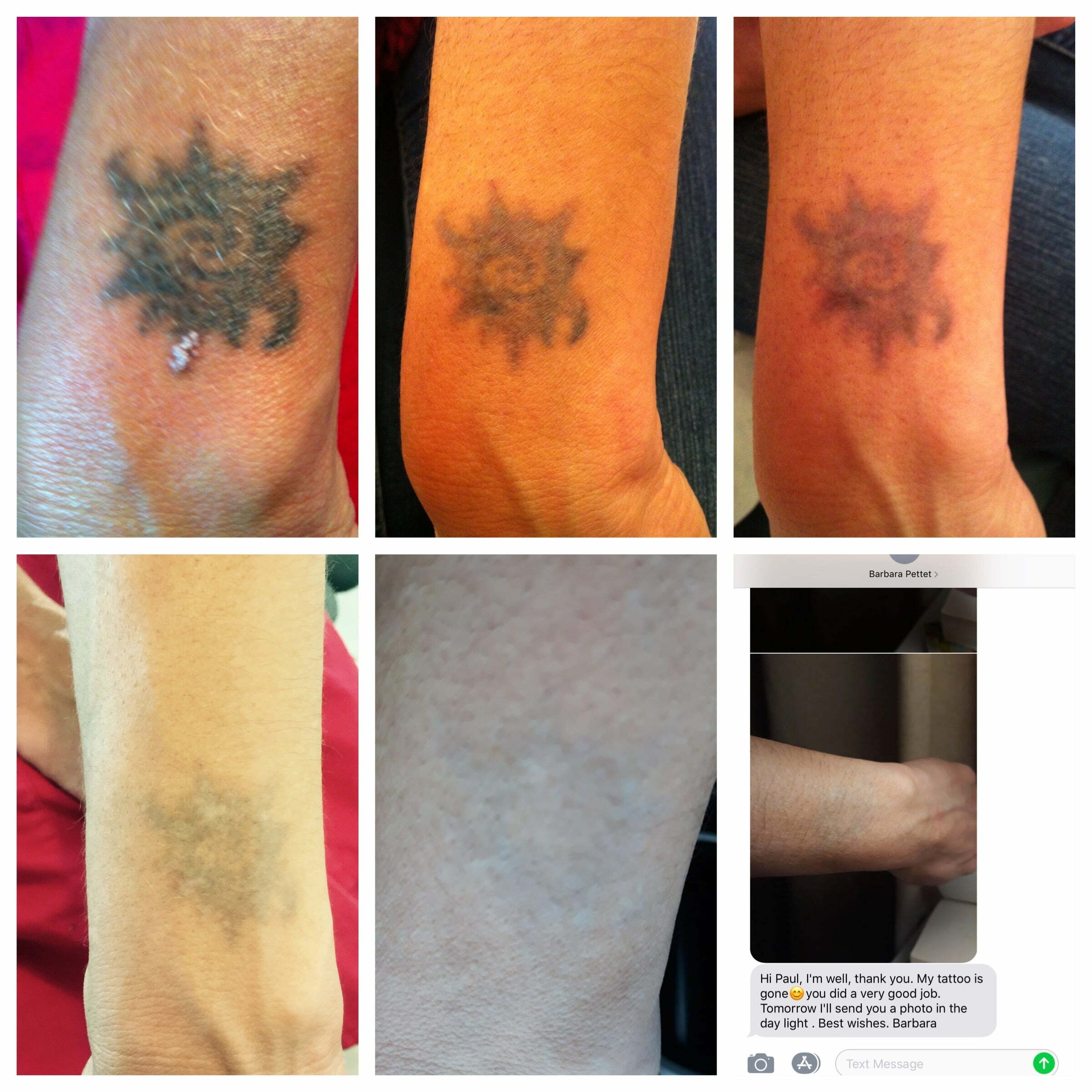 Tattoo Removal - Skin Beautiful